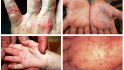 Що таке вірус Коксакі?